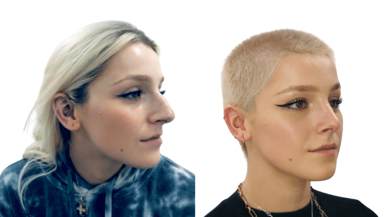 Rhinoplasty before and after, three-quarter view after primary rhinoplasty, Centre for Surgery London