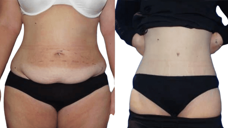 Tummy tuck before and after photos, front view
