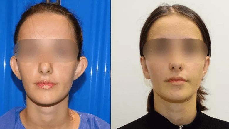 Otoplasty before and after, front view with prominent ears set closer to the head, Centre for Surgery London