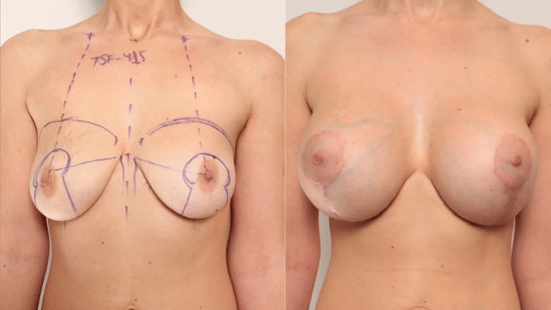 Breast lift with implants before and after at Centre for Surgery London