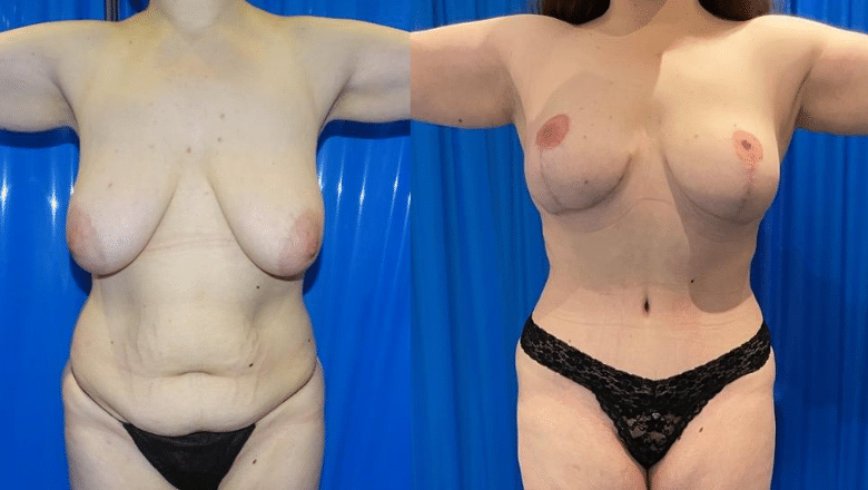 Mummy makeover before and after results