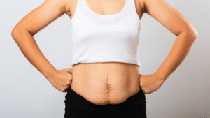 Body Shaping Surgery after Massive Weight Loss