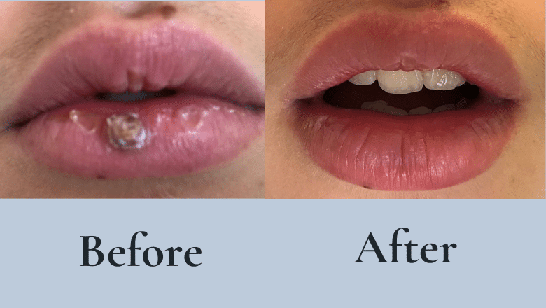 Pyogenic granuloma removal with laser before and after