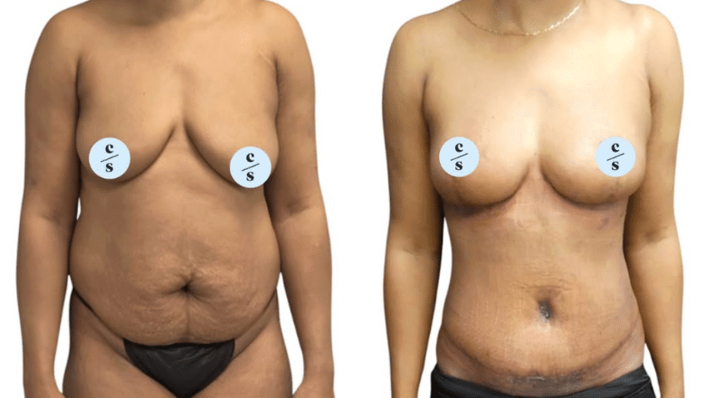 Mummy makeover before and after photos, front view