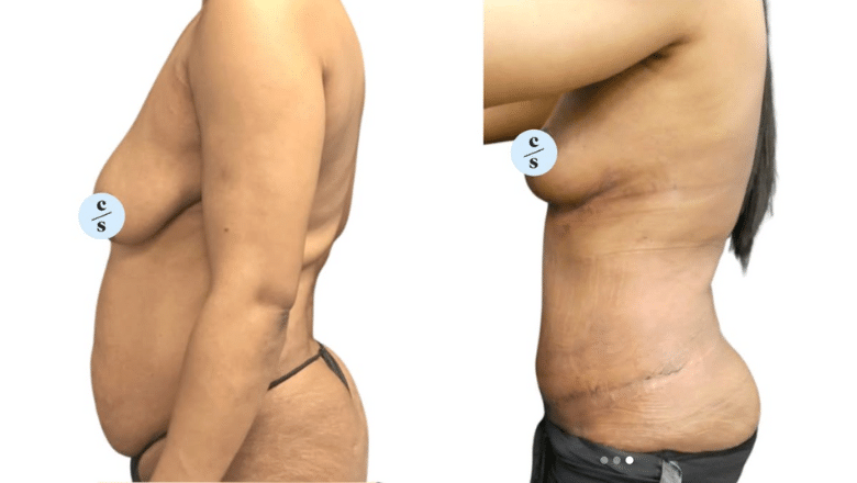 Mummy makeover before and after photos, side view