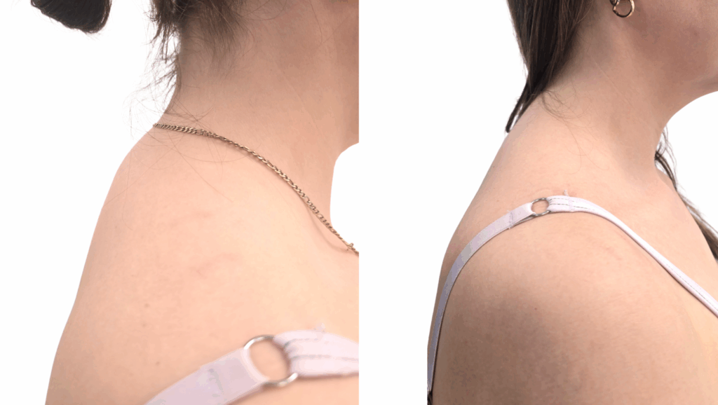 Buffalo hump removal before and after results at Centre for Surgery London
