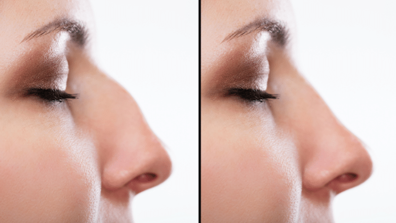 How to read plastic surgery before and after photos