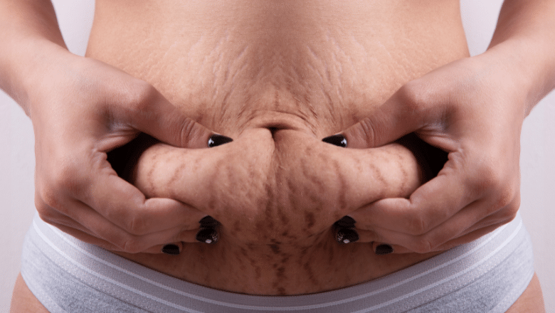 Getting Rid of Stretch Marks Following Pregnancy — Centre for Surgery London