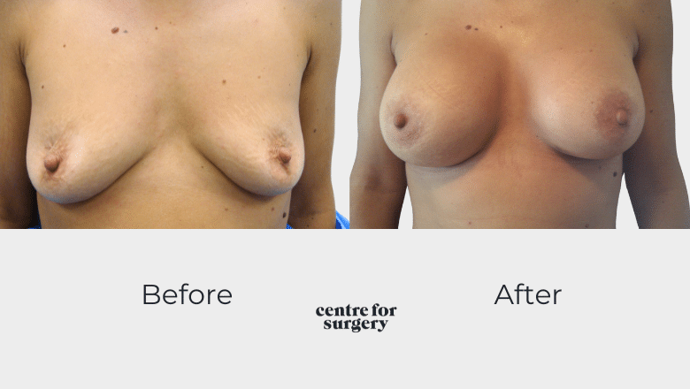 Breast uplift with implants before and after at Centre for Surgery London