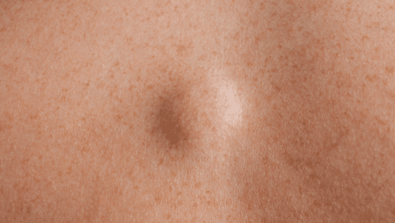 Same-day lipoma removal at Centre for Surgery London