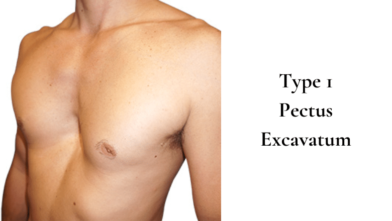 Type 1 Pectus Excavatum