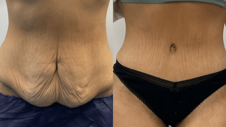 female tummy tuck before after