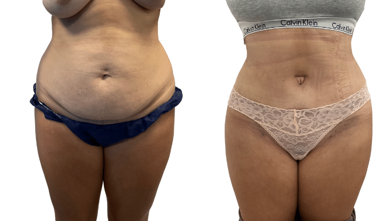 Tummy Tuck Liposuction