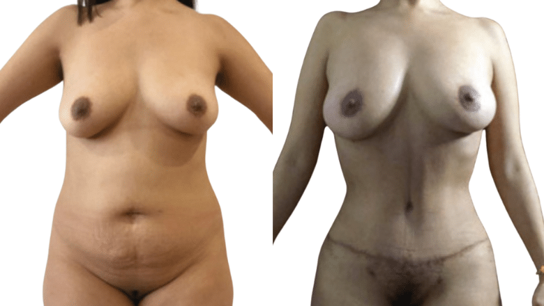 mummy makeover tummy tuck and breast lift before after