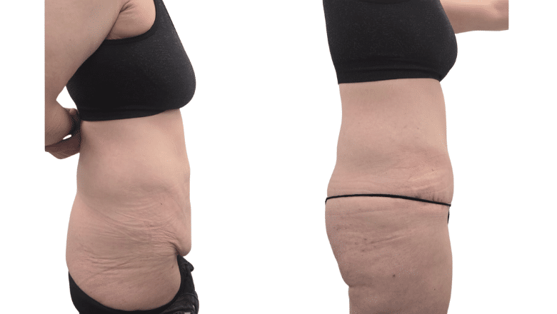 lipo for c section pouch How do I get rid of C section overhang?