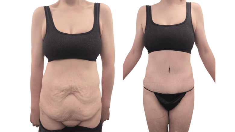 Tummy tuck before and after results