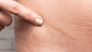 Can White Scars Be Removed Completely