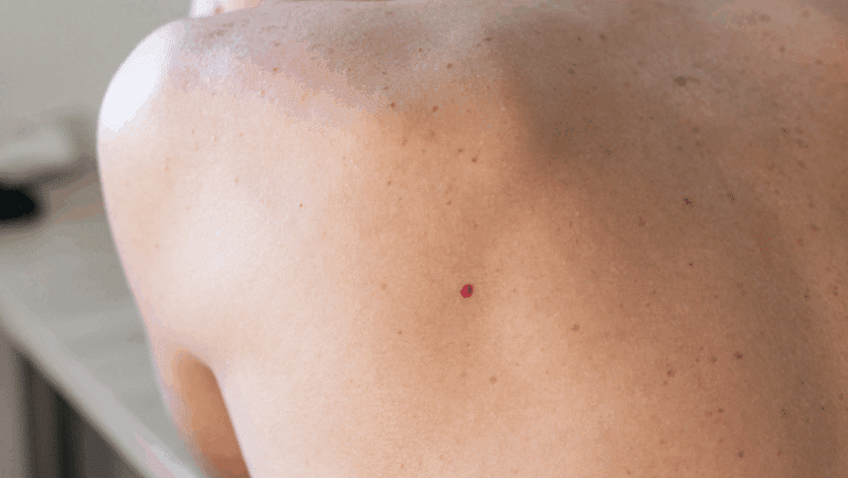 Can Laser Treatment Remove Cherry Angiomas Permanently
