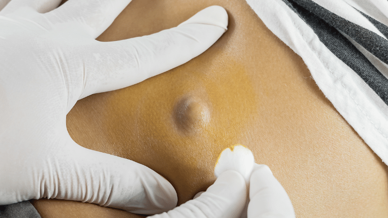 Can you remove a cyst at home — Centre for Surgery London