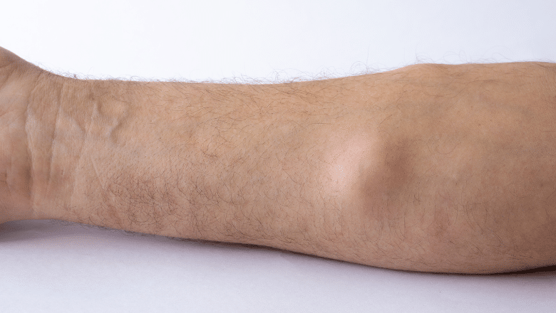 Do lipomas come back after removal — Centre for Surgery London