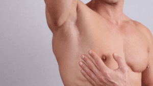 Does Gynecomastia Increase The Risk Of Breast Cancer In Men