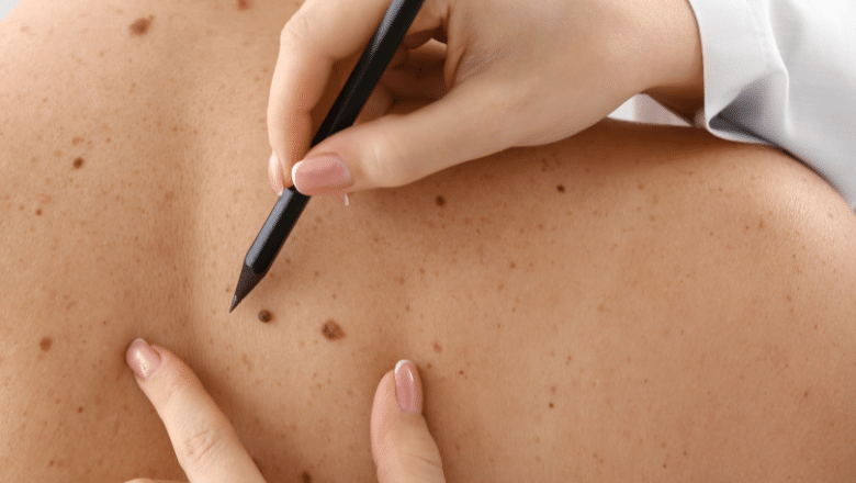Should every removed mole be sent for biopsy — Centre for Surgery London