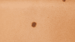 Can All Moles Be Safely Removed