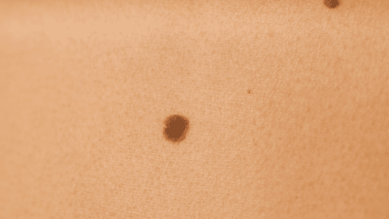 Can All Moles Be Safely Removed