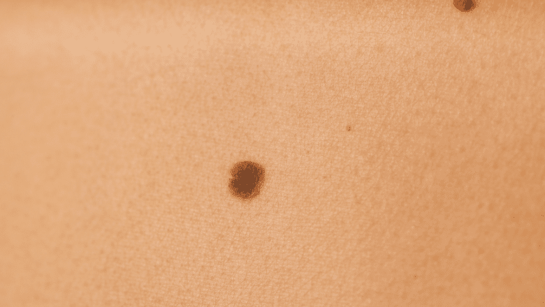 Can all moles be safely removed — Centre for Surgery London