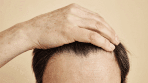 Is Forehead Reduction Suitable for Patients with Receding Hairlines