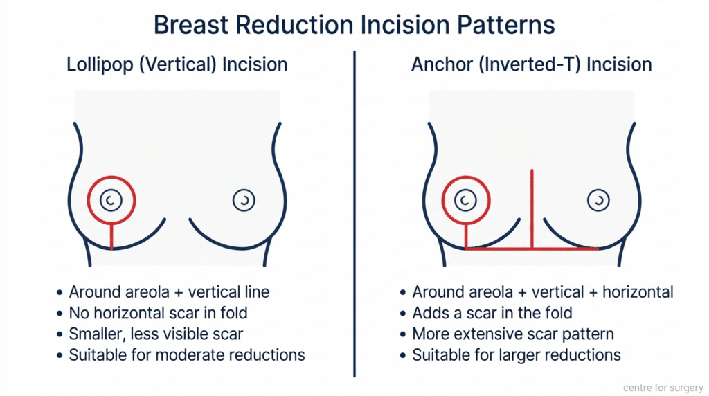 Anchor Incision Pattern Breast Reduction Mammoplasty London | Centre for Surgery