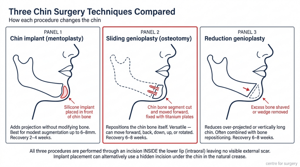 Chin Surgery (Genioplasty) London & UK | Centre for Surgery