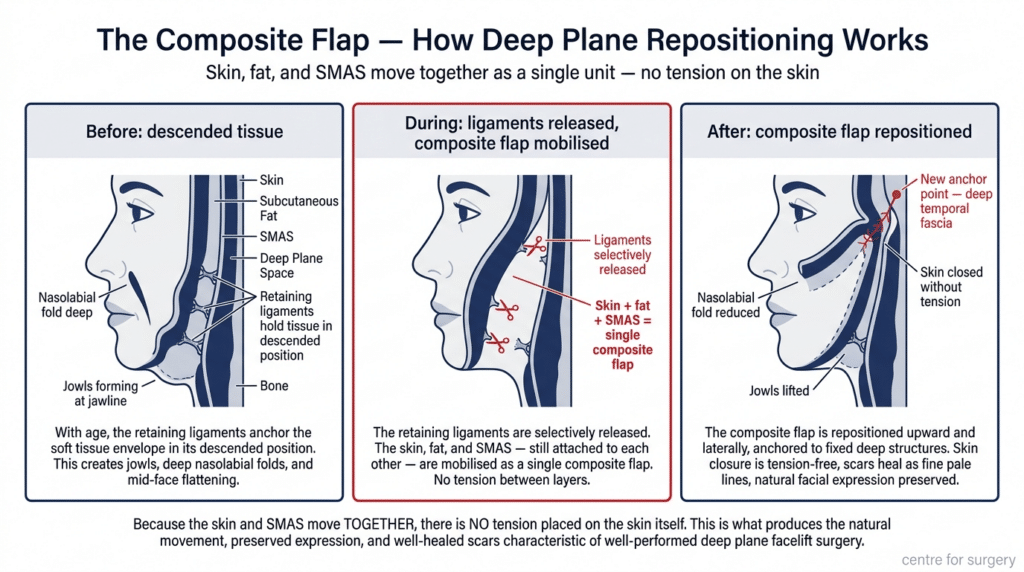 Deep Plane Facelift London | Deep Plane Face Lifting UK