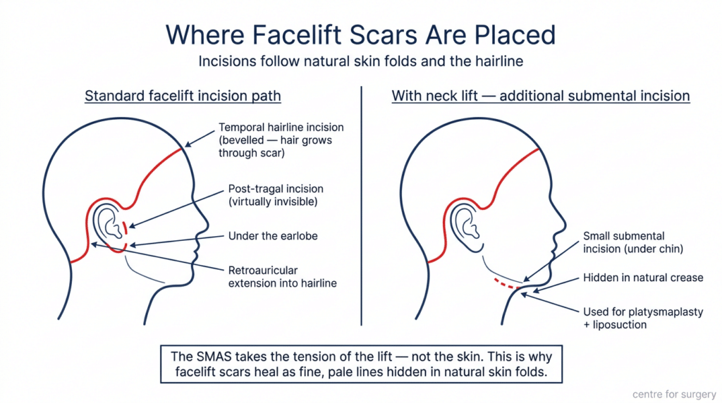Posttragal Facelift London | SMAS & Deep Plane Facelift | Centre for Surgery