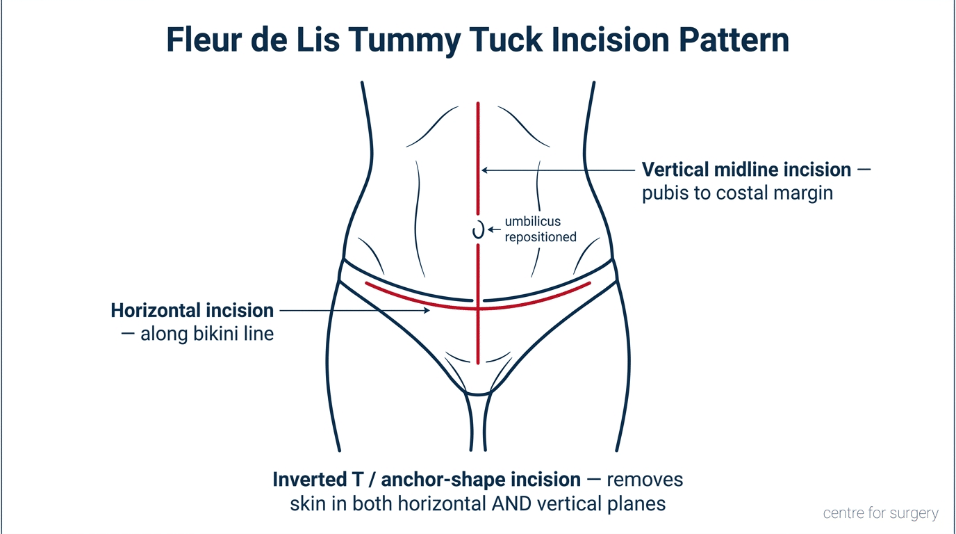 Anchor Incision Pattern Fleur de Lis Tummy Tuck London | FDL Abdominoplasty | Centre for Surgery