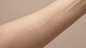 Close-up of healed skin showing a fine pale mole removal scar — Centre for Surgery London