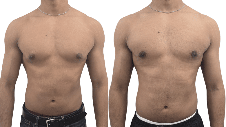Gynaecomastia surgery before and after at Centre for Surgery London — glandular tissue excised with liposuction of the surrounding chest fat, anterior view
