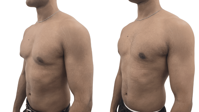 Gynaecomastia and chest fat before and after at Centre for Surgery London — flat masculine chest contour restored, oblique view
