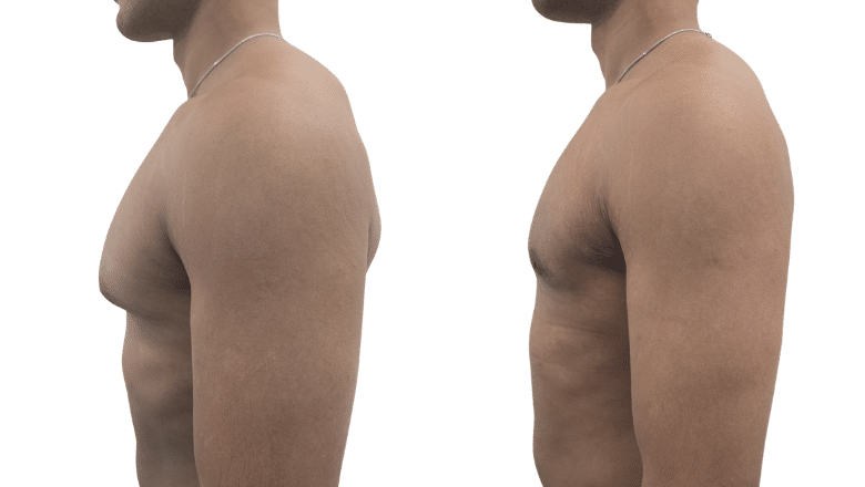 Male chest reduction before and after at Centre for Surgery London — combined glandular excision and liposuction, three views