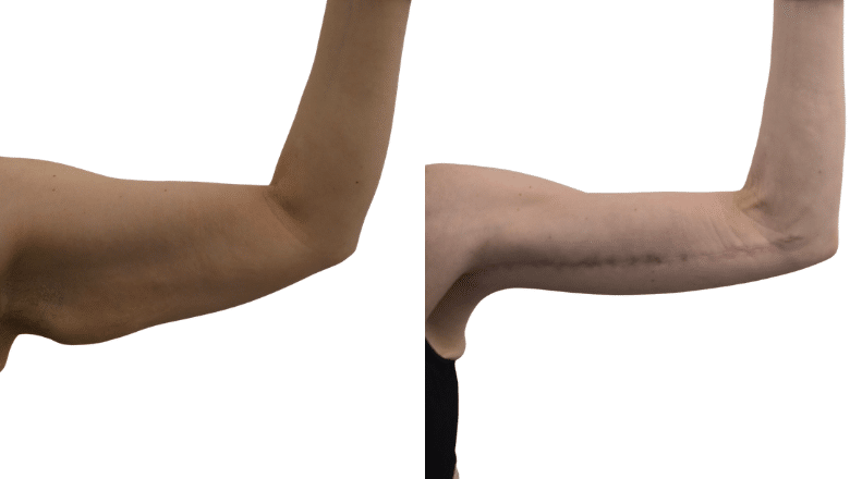 Arm lift brachioplasty before and after showing removal of excess upper arm skin — Centre for Surgery London