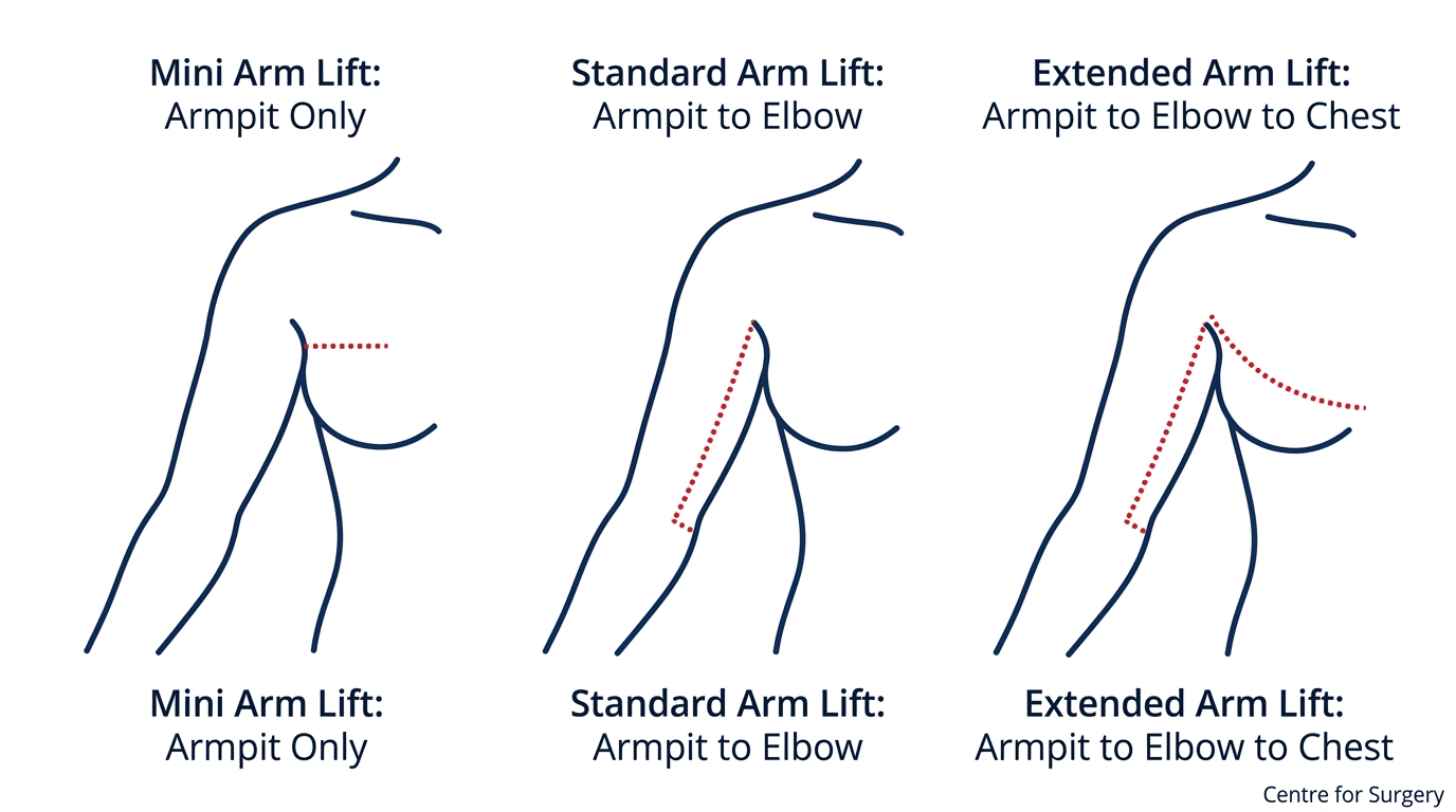 Comparison diagram of mini, standard, and extended arm lift incision types at Centre for Surgery London