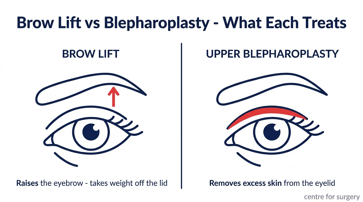 Diagram comparing what a brow lift and an upper blepharoplasty each treat — the brow lift raises the eyebrow to take weight off the lid, the blepharoplasty removes excess skin from the eyelid itself, Centre for Surgery London
