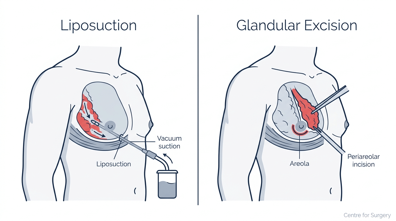 Diagram comparing liposuction and glandular excision techniques for gynecomastia surgery