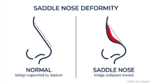Comparison of a normal nose profile with a saddle nose deformity showing the collapsed bridge and upturned tip, Centre for Surgery London