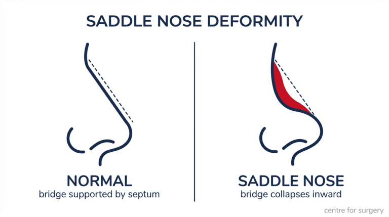 Comparison of a normal nose profile with a saddle nose deformity showing the collapsed bridge and upturned tip, Centre for Surgery London