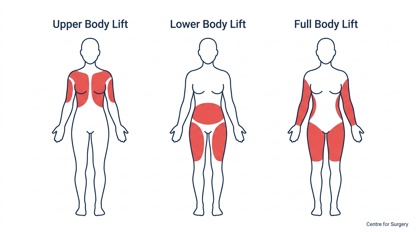 Diagram comparing upper body lift, lower body lift and full body lift zones on the body at Centre for Surgery London