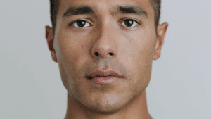 Front-facing portrait showing overall nose width — wide nose assessment and treatment options, Centre for Surgery London