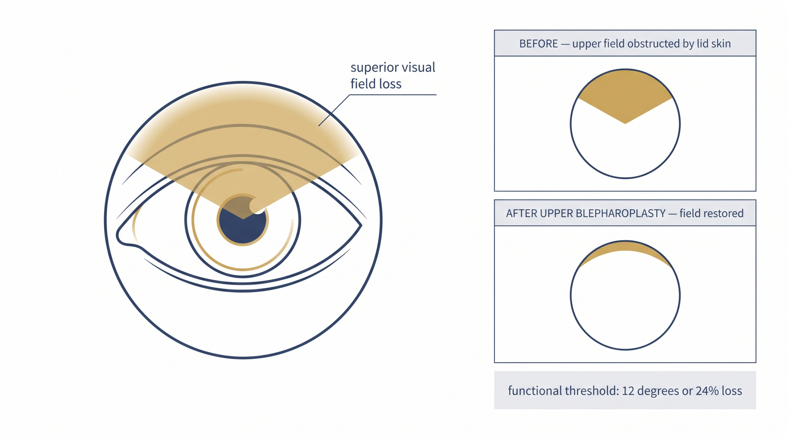Diagram showing superior visual field loss caused by hooded upper eyelid skin before upper blepharoplasty and the restored field afterwards, with the functional threshold of 12 degrees or 24 percent loss marked