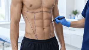Surgeon marking planning lines on a man's chest, waist and abdomen before male body contouring surgery in London