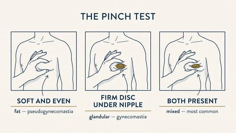 The pinch test for pseudogynecomastia — soft and even tissue indicates fat, a firm disc under the nipple indicates glandular tissue, and both may be present together